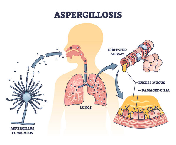 Aspergillosis lung infection caused by Aspergillus, vector outline diagram