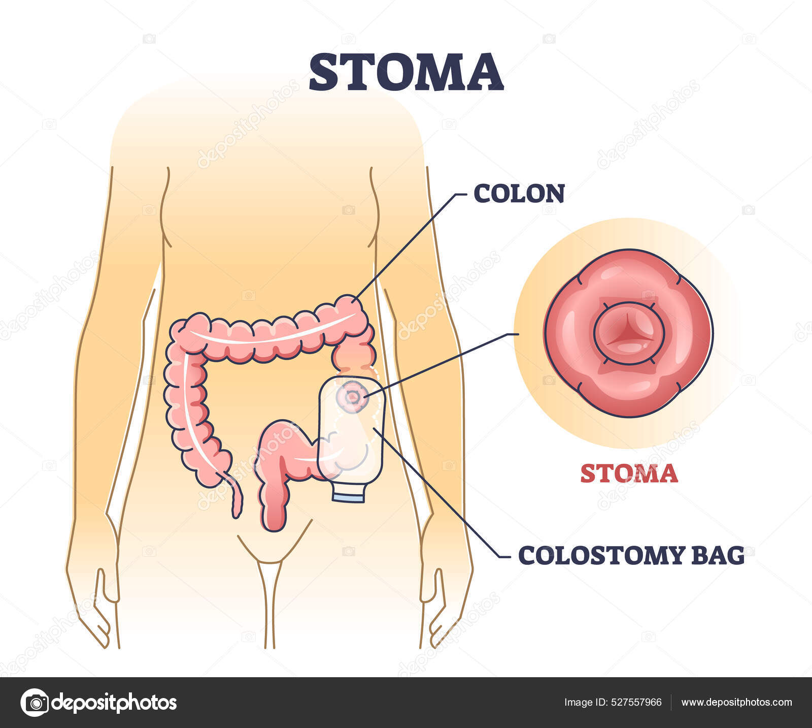 How To Change Stoma Bag? A Step-By Step Guide – SM Health Care