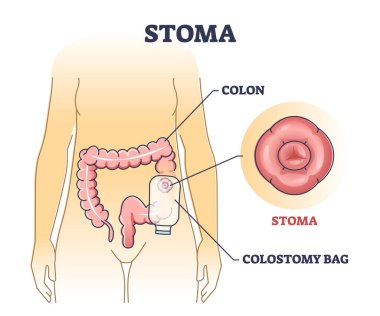 Tıbbi hasta drenaj şeması olarak kolon ameliyatından sonra stoma torbası