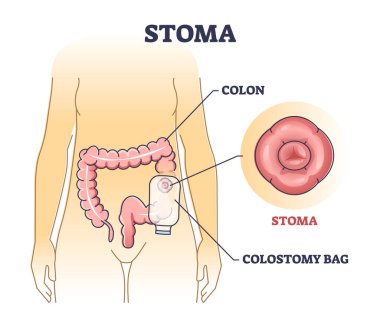 Stoma bag after colon surgery as medical patient drainage outline diagram clipart