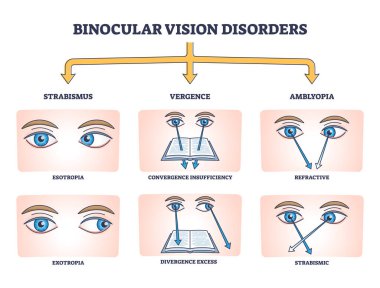 Binocular vision disorders with all eye defect examples outline diagram clipart