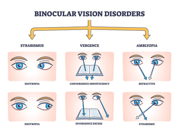 Binocular vision disorders with all eye defect examples outline diagram