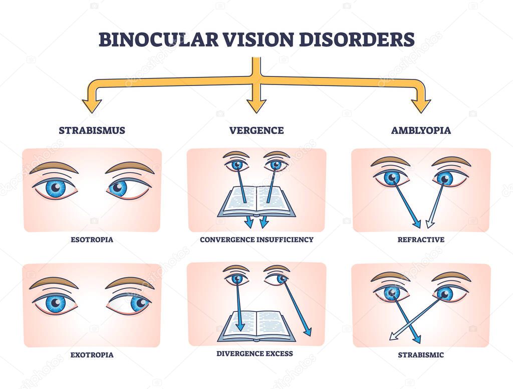 Binocular vision disorders with all eye defect examples outline diagram