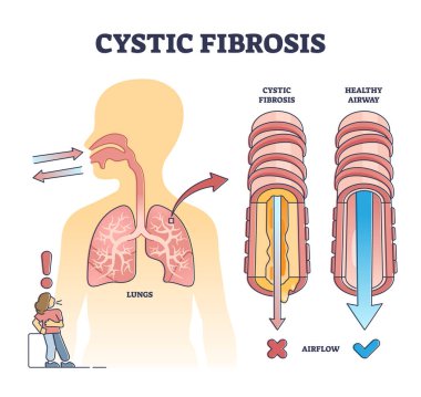 Kistik fibrozis bozukluğu veya sağlıklı hava akımı hava yolu karşılaştırma şeması