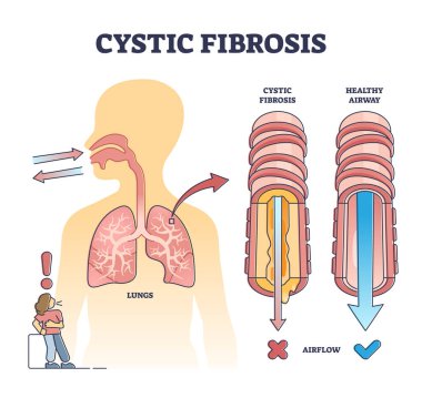 Cystic fibrosis disorder or healthy airflow airway comparison outline diagram clipart