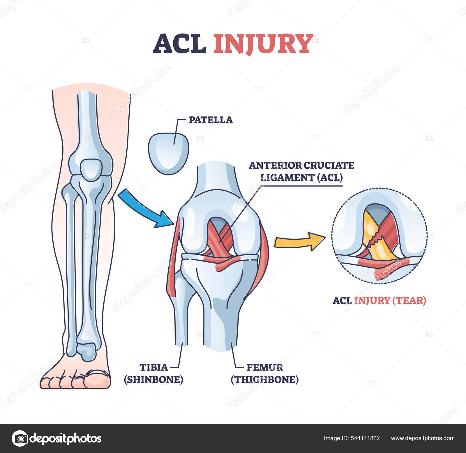 ACL Injury Or Trauma As Tear Or Sprain Of Anterior Cruciate Outline acl-injury-or-trauma-as-tear-or-sprain-of-anterior-cruciate-outline