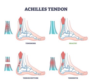 Achilles tendon hasarı bacak ya da bilek travması örnekleri çizelgesi olarak yazılır.