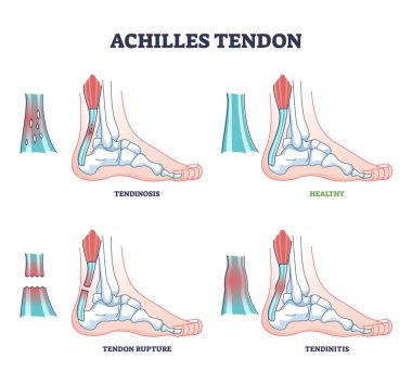 Achilles tendon injury types as leg or ankle trauma examples outline diagram clipart