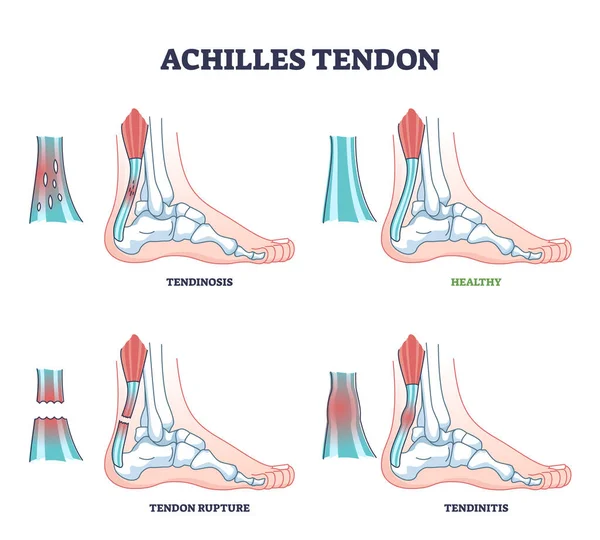 Tipos de lesiones del tendón de Aquiles como ejemplos de traumatismos en las piernas o los tobillos diagrama esquemático — Vector de stock