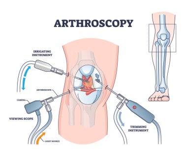 Arthroscopy procedure as knee diagnostics process explanation outline diagram clipart