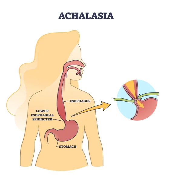 Esophageal achalasia disease with lower sphincter failure outline diagram — Stock Vector