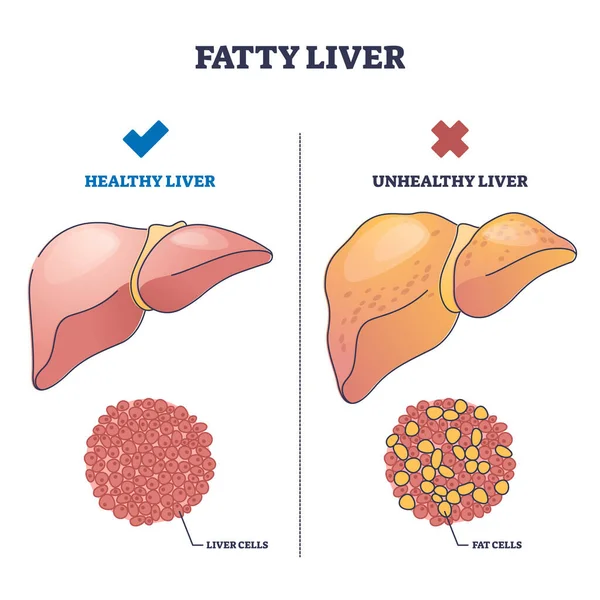 Doença hepática gorda com diagrama de contorno de comparação de órgãos saudáveis e danificados —  Vetores de Stock