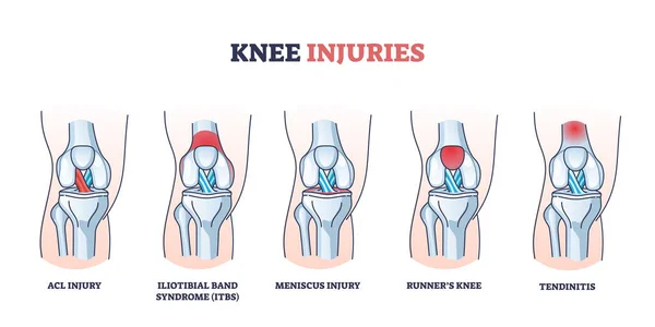 Lesiones de rodilla con hueso médico, ligamento y traumatismo muscular diagrama de contorno — Vector de stock