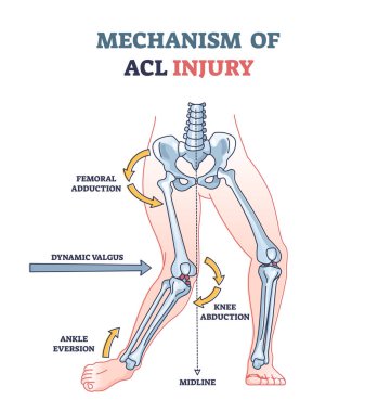 Mechanism of ACL injury as knee trauma anatomical explanation outline diagram clipart