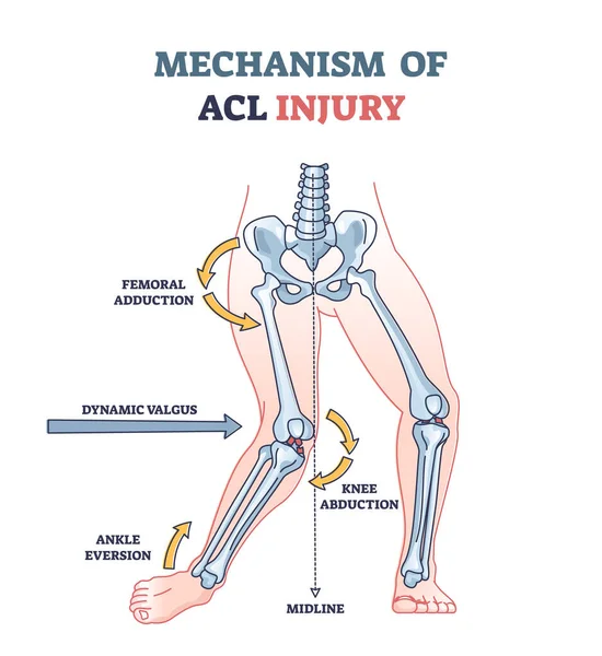 Mécanisme de la blessure ACL comme traumatisme du genou explication anatomique schéma — Image vectorielle