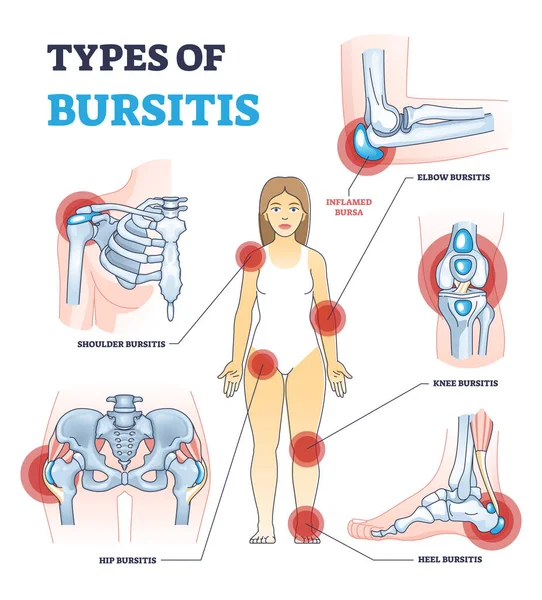 Tipos de bursitis como articulaciones del cuerpo médico lista de inflamación esquema diagrama — Vector de stock