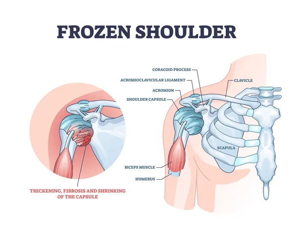 Condición del hombro congelado o síndrome de capsulitis adhesiva diagrama del contorno — Archivo Imágenes Vectoriales