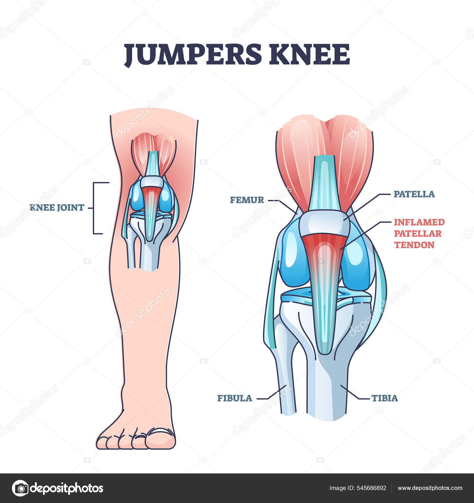 Fulcrum Injury Of Joint