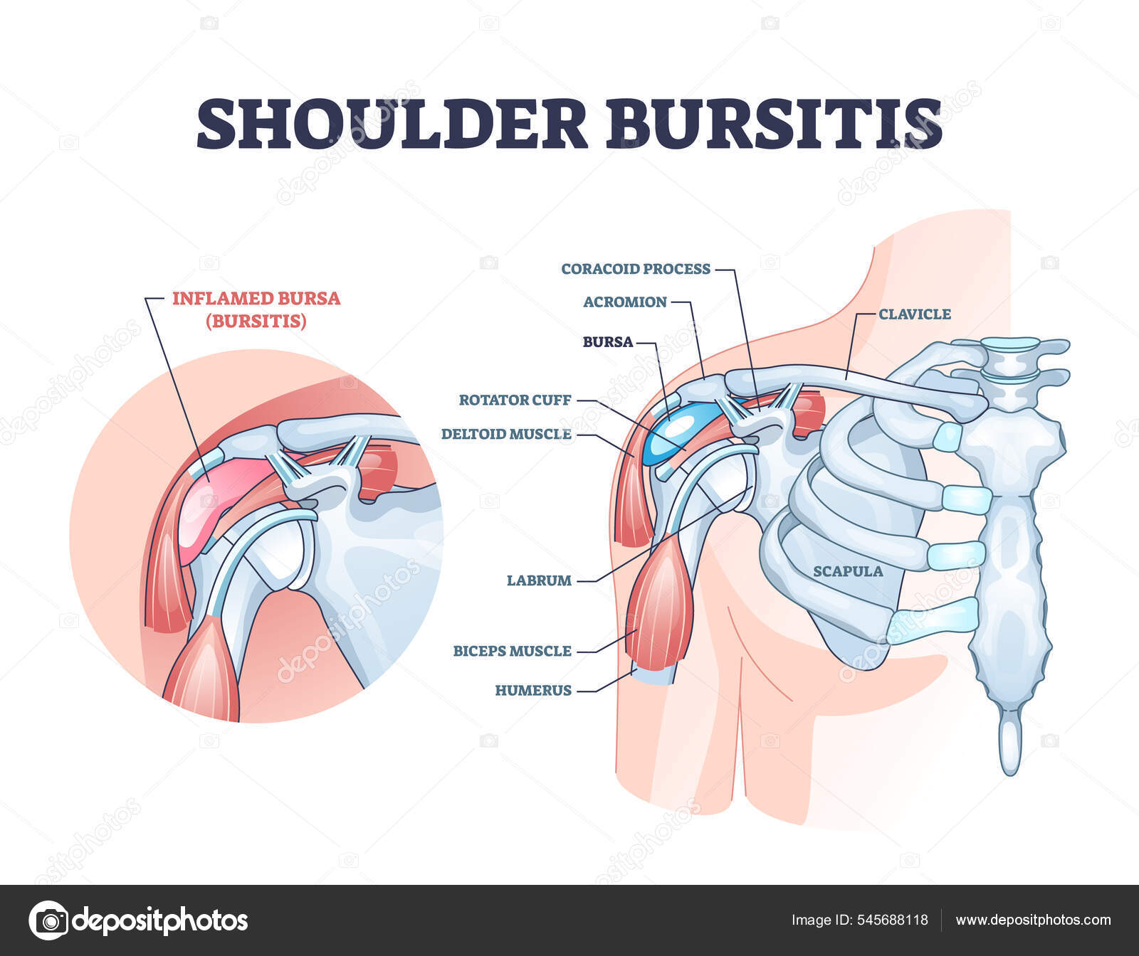 Shoulder bursitis as medical painful bursa inflammation outline diagram