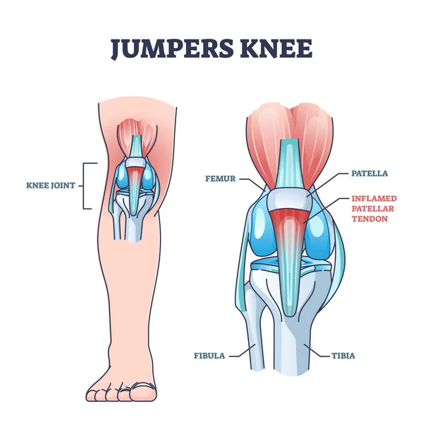 Saltadores rodilla o tendinitis rotuliana tendón inflamación ósea esquema diagrama — Vector de stock