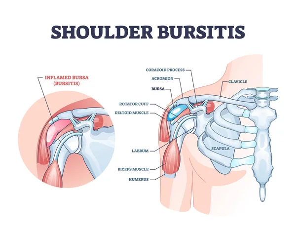 통증 이 있는 부르사 염증 골조 그림으로 어깨 궤양 — 스톡 벡터