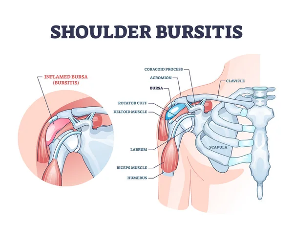 Schouder bursitis als medische pijnlijke bursa ontsteking schema — Stockvector