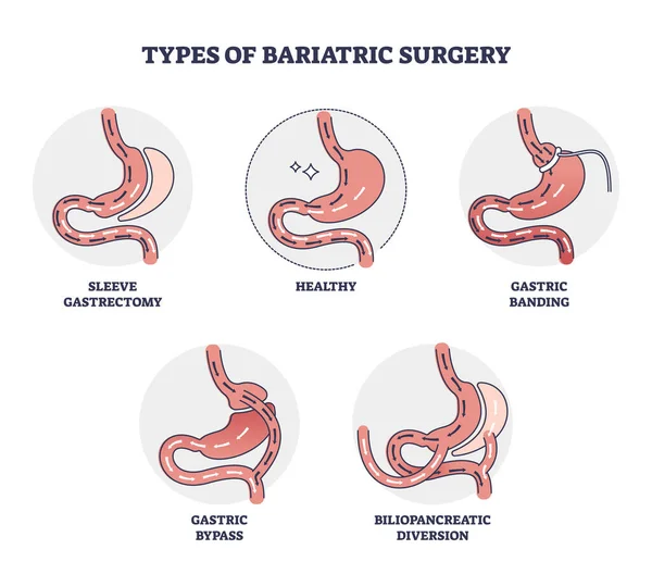 Types de chirurgie bariatrique et schéma de contrôle de la réduction de l'estomac — Image vectorielle