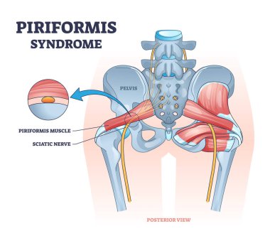 Piriforis sendromu ve siyatik sinir sıkışması acı diyagramı.