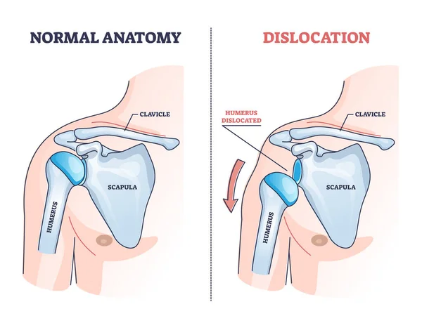 Dislocación del hombro y traumatismo óseo húmero explicación esquema diagrama — Vector de stock