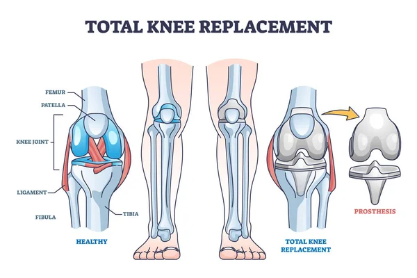 Intervento di sostituzione totale del ginocchio e schema schematico dell'operazione di protesi — Vettoriale Stock