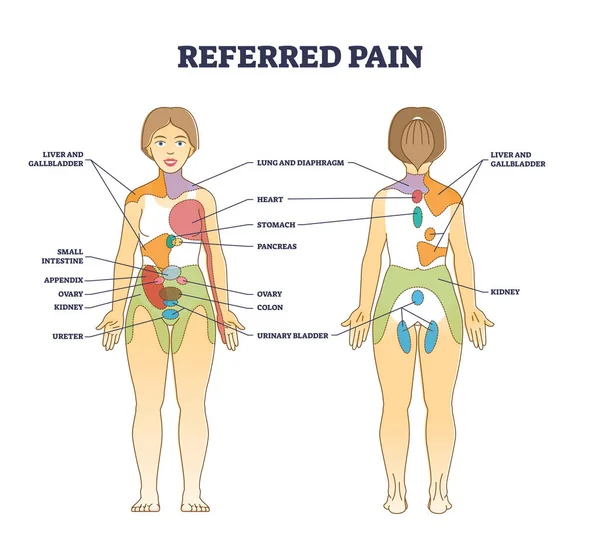 Localización del dolor referido como cuerpo estímulo doloroso origen del órgano esquema diagrama — Vector de stock