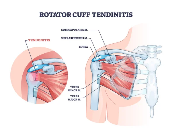 Tendinitis del manguito rotador como diagrama de contorno de inflamación muscular del hombro — Archivo Imágenes Vectoriales