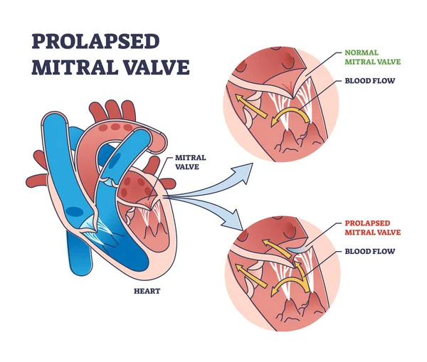 Válvula mitral prolapsada cardiopatía comparación con diagrama de contorno normal — Vector de stock