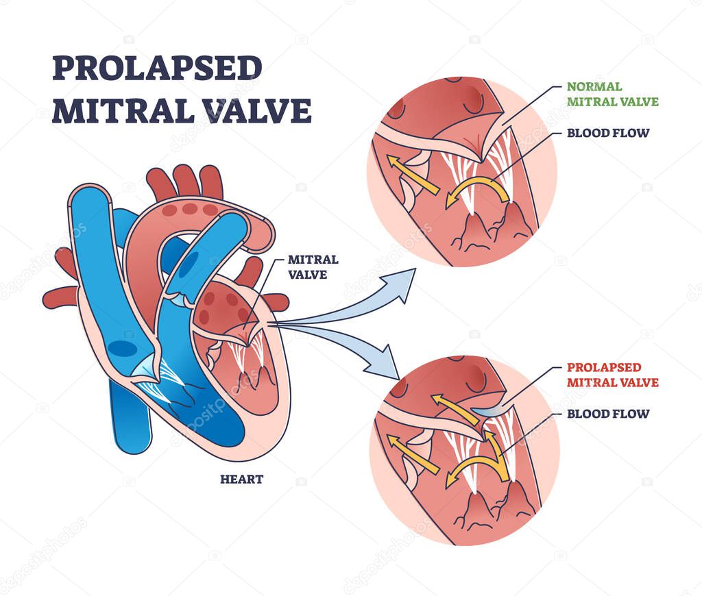 Prolapsed mitral valve heart disease comparison with normal outline diagram