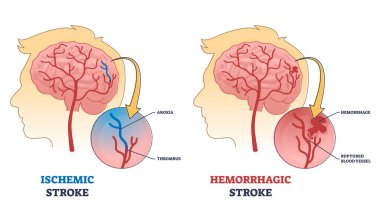 İskemik ve kanamalı kafa darbesi anatomik karşılaştırma şeması