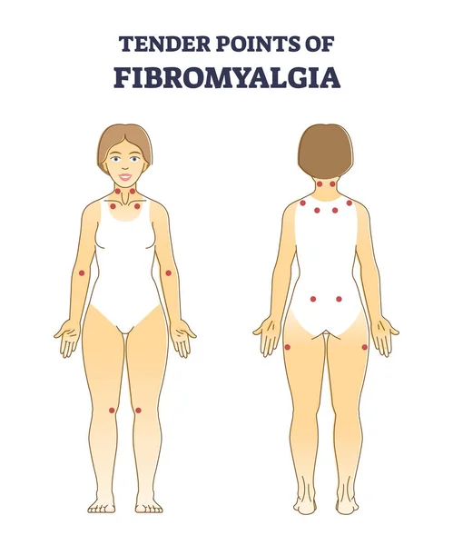 Tender points of fibromyalgia with pain location on body outline diagram — Stock Vector