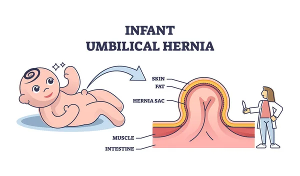 Infant umbilical hernia as painless lump near belly button outline diagram - Stok Vektor