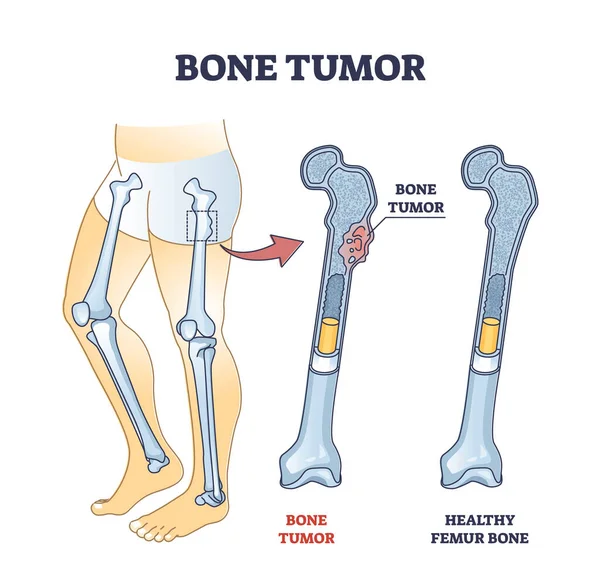 Bottumor als abdominale weefselgroei op menselijk skelet schema — Stockvector