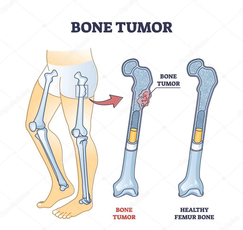 Bone tumor as abdominal tissue growth on human skeleton outline diagram