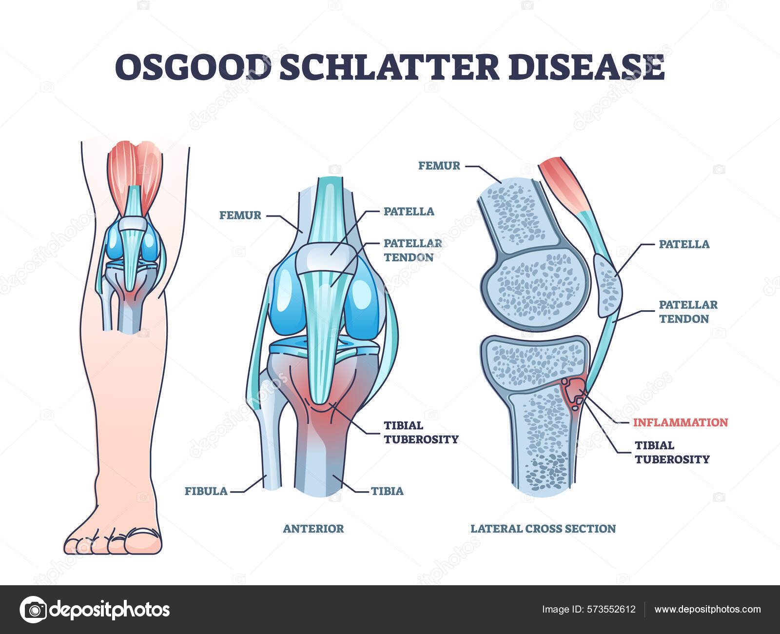 Osgood schlatter disease condition with knee joint pain outline diagram
