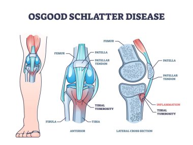 Diz eklem ağrısı diyagramı olan Osgood schlatter hastalığı