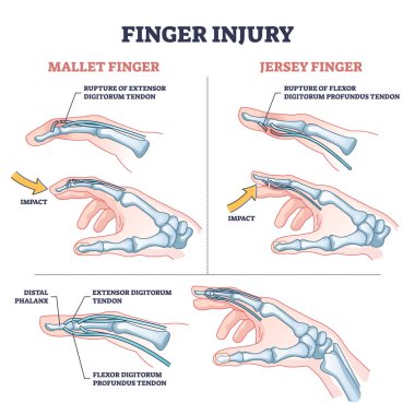 Finger injury types with common hand impact trauma anatomy outline diagram clipart
