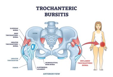 Kalça çizgisi diyagramında bulunan bursa iltihabı olarak trochanterik bursitis