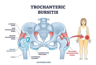 Trochanteric bursitis as bursa inflammation located in hip outline diagram clipart