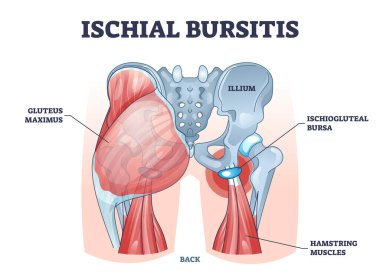 Ischial bursitis ya da ischiogluteal dokumacı alt durum şeması