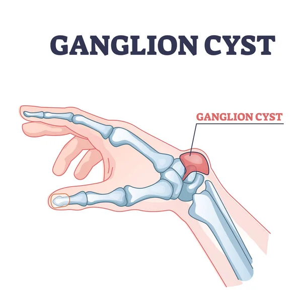 Quiste de ganglio como líquido tendinoso hinchazón cerca del brazo diagrama del contorno de la articulación — Archivo Imágenes Vectoriales