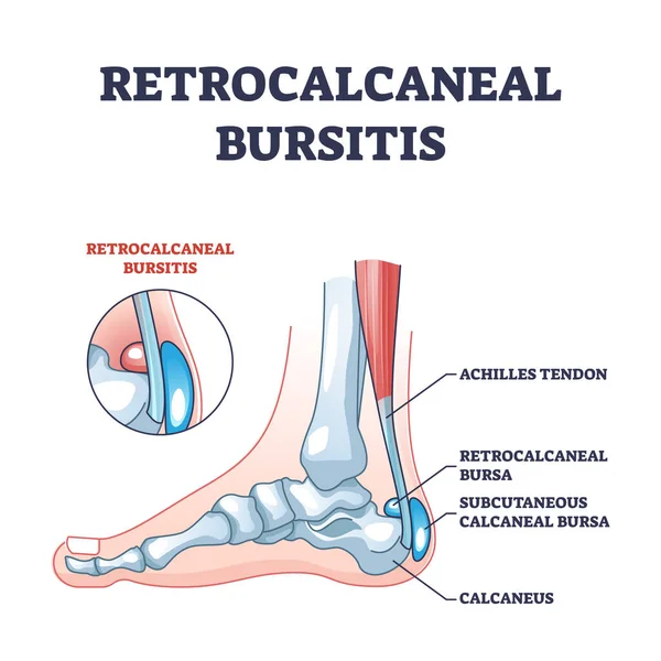 Bursitis retrocalcánea como tobillo o tendón de Aquiles bursa diagrama de contorno — Archivo Imágenes Vectoriales