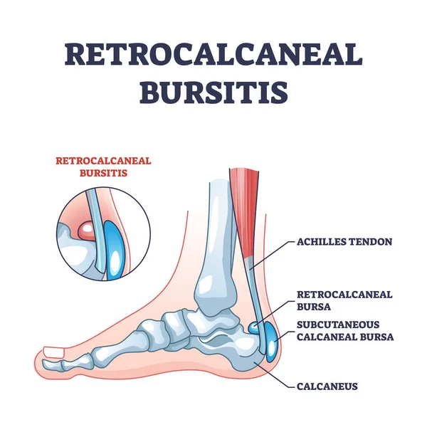 Retrokalcaneal bursit som ankel eller akillessena bursa konturdiagram — Stock vektor