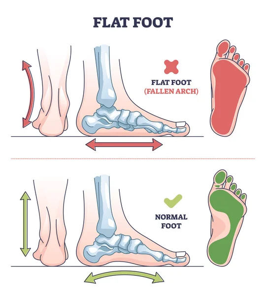 Patología del pie plano con diagrama de contorno de comparación de arco caído y normal — Vector de stock