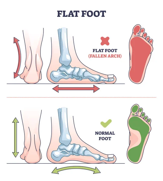 Pathologie du pied plat avec diagramme de contour de comparaison d'arc tombé et normal — Image vectorielle